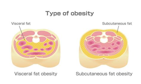 Type Of Obesity Illustration Abdominal Sectional View Visceral Fat