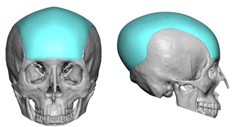 Blog Archivecase Study Large Custom Skull Implant Replacement
