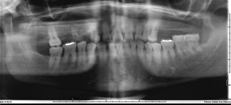 Periosteal Osteosarcoma Of The Mandible A Case Report Journal Of