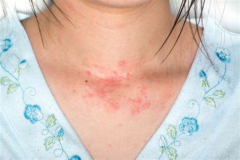 Allergic Reaction Skin Rash
