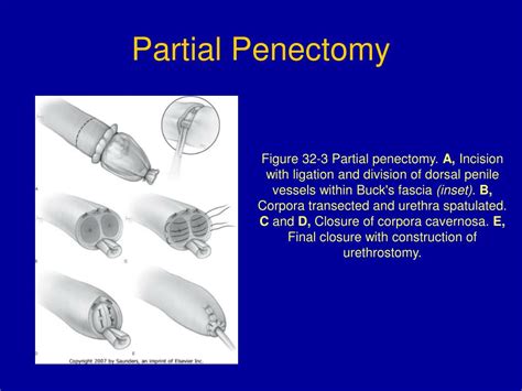 Ppt Surgery Of Penile And Urethral Carcinoma Powerpoint Presentation