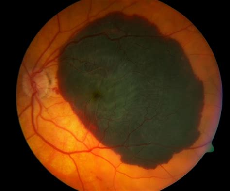 Subfoveal Subretinal Hemorrhage Retina Image Bank