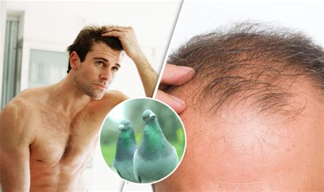 Baldness Cures Men Have Tried Over The Years But Do The Hair Loss