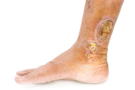 Venous Leg Ulcers Evidence Review Evidently Cochrane My XXX Hot Girl
