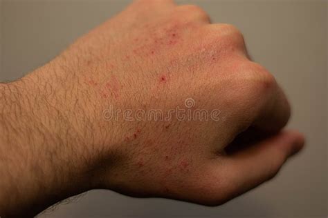 Closeup Of The Hand Of A Person Covered In Small Itchy Bumps Under The