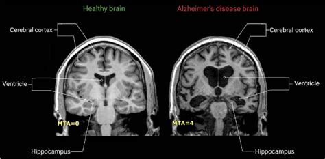 Ad Leads To Hippocampal Atrophy And Ventricle Enlargement Healthy