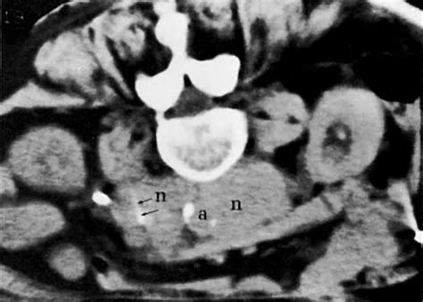 Abnormal Ct Scan Of Neck Lymph Nodes Ct Scan Machine