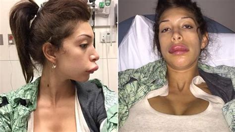 Teen Moms Farrah Abraham Reveals Botched Lip Surgery In Shocking