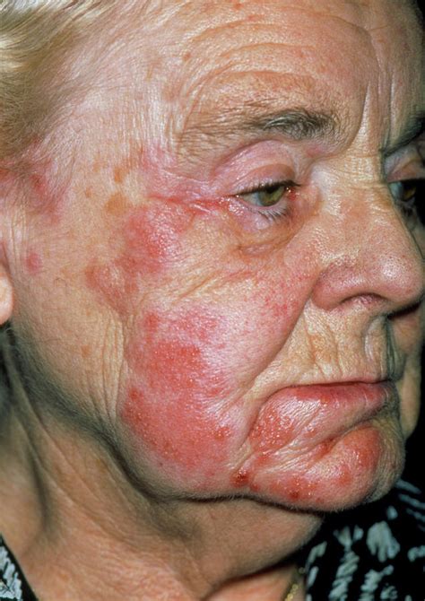 Herpes Zoster Rash On An Elderly Woman S Face Photograph By Dr P Marazzi Science Photo Library