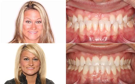Before And After Orthocare Orthodontics Charlotte Nc Spartanburg Sc