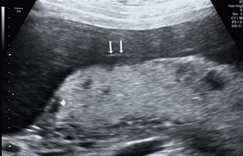 Abnormal Placenta Ultrasound Images