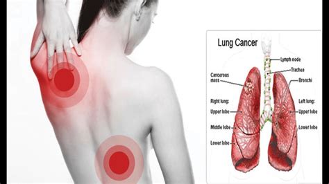Lung Cancer Symptoms All Most Common Signs Of Lung Cancer Full Hot Sex Picture