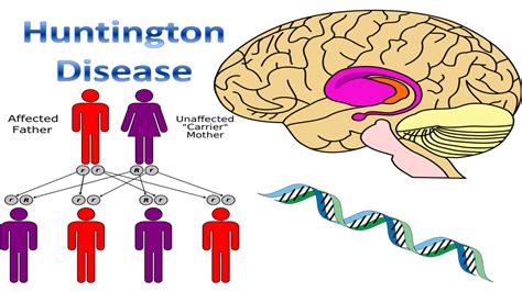 Despite distressing symptoms, be at ease knowing that you (or your loved one, if you are a caregiver). Huntington's Disease| Causes, Symptoms & Treatment ...