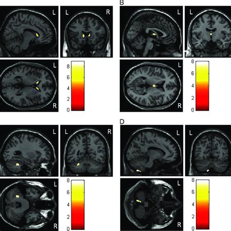 Grey Matter Density Values For Each Group In The A Left Caudate Head