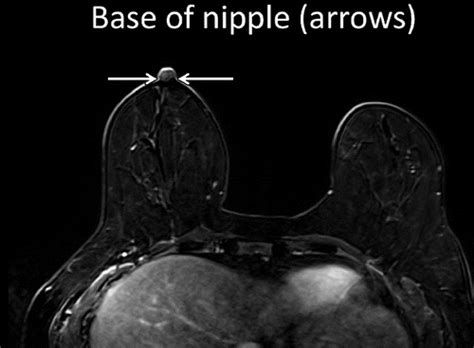 An Analysis Of Nipple Enhancement At Breast MRI With Radiologic