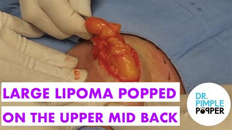 Large Lipoma On The Back Extreme Excisions Dr Pimple Popper