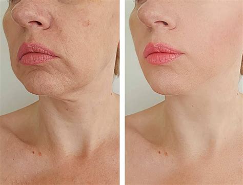 Microneedling Jacksonville – Microneedling Benefits