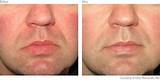 Laser Treatments For Rosacea On Face Photos