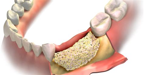 Local Bone Graft After Tooth Extraction Blog Site Discussion Online