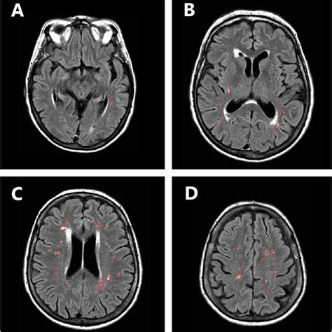 Periventricular And Subcortical White Matter Hyperintensities Mri