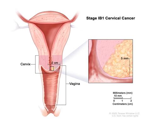 Cervical Cancer Treatment PDQ Patient Version NCI