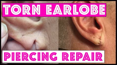 Surgical Repair Of A Torn Earlobe Youtube