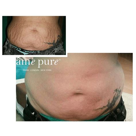 Intensive Stretch Marks Eraser âme Pure Amepureeu