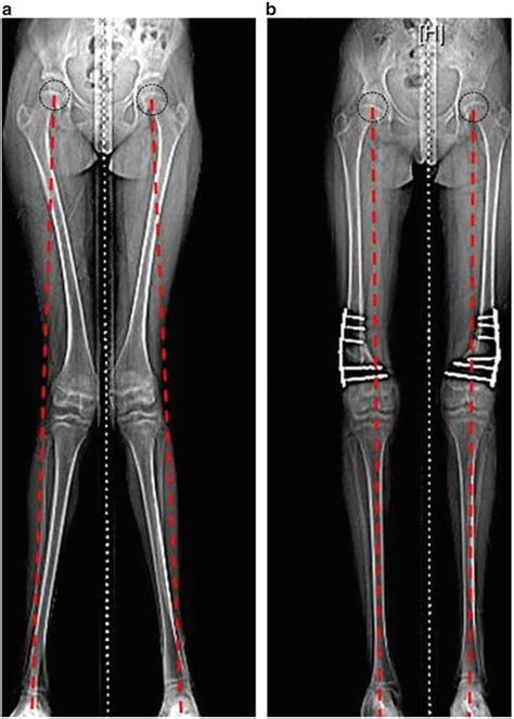 Acute Deformity Correction Using An Osteotomy Obgyn Key