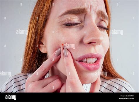 Redhead Student Woman Squeezing Her Pimples Removing Pimple From Her