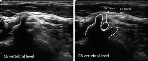 Cervical Nerve Root Block Anesthesia Key