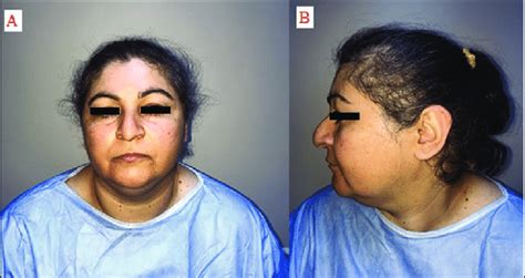 Preoperative Frontal And Profile Views Of The Patient Download