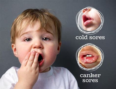 Toddler Cold Sore Is One Of The Highly Contagious Viruses Daily Medicos