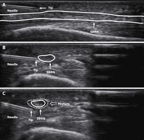 Ultrasound Guided Needle Release Plus Corticosteroid Injection Of
