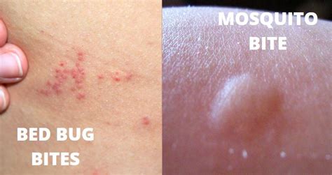Bed Bug Vs Mosquito Bites In 7 Points Explained Y L P C