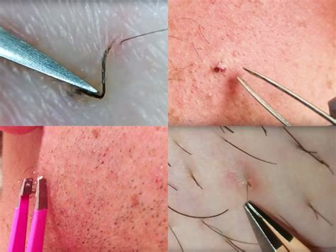 These Are Best Most Satisfying Ingrown Hair Removal Videos On The Internet Pimplespopping