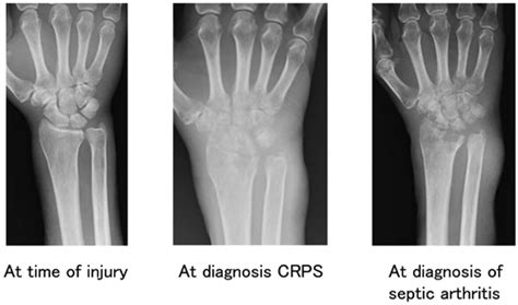 Septic Arthritis Of The Hand During Treatment Of Complex Regional Pain