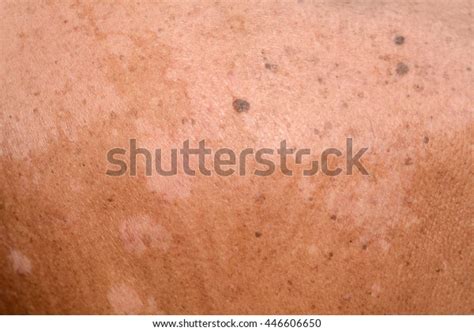 Tinea Versicolorpityriasis Versicolor On Skin Stock Photo Edit Now