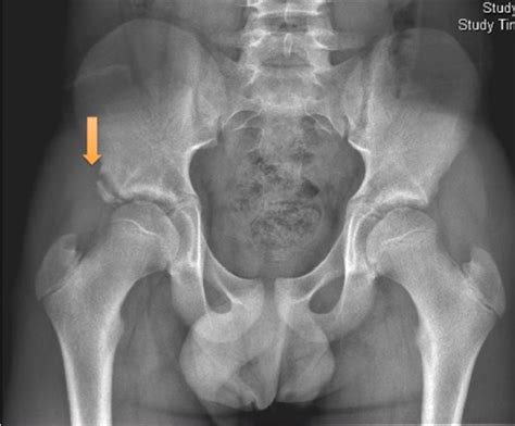 It refers to the anterior extremity of the iliac crest of the pelvis. Full text Evaluation, management and prevention of lower ...