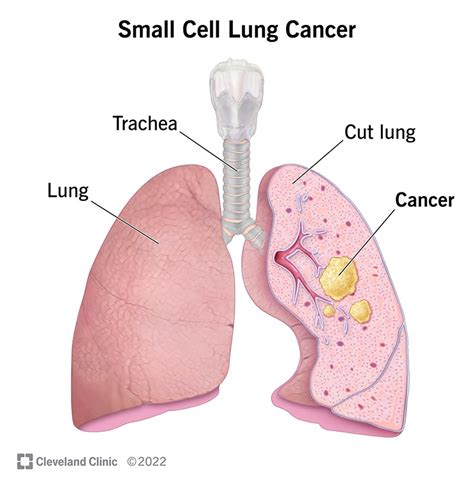 Small Cell Lung Cancer Symptoms Causes Treatment