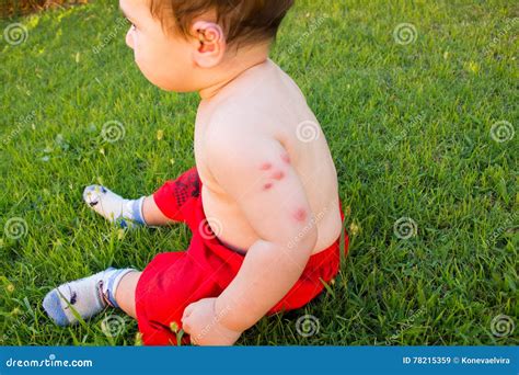 New Born With Multiple Mosquito Bites Allergy To Insect Bites Stock