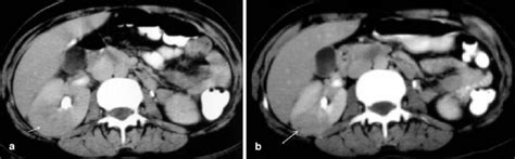 A B Acute Pyelonephritis A Contrast Enhanced Ct Scan Showing Diffuse