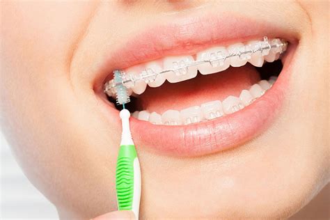 Oral Hygiene With Brace Starlight Dental Clinic