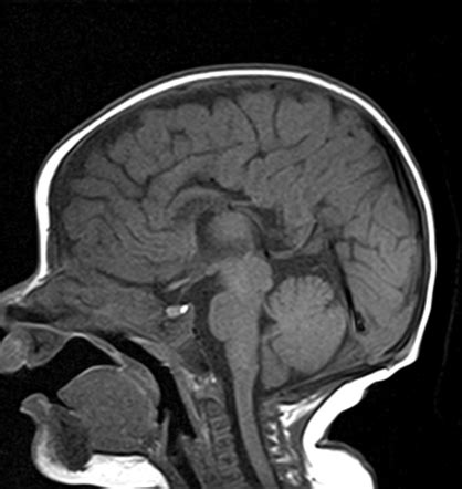Dysgenesis Of Corpus Callosum With Atretic Occipital Cephalocele Radiology Case Radiopaedia Org
