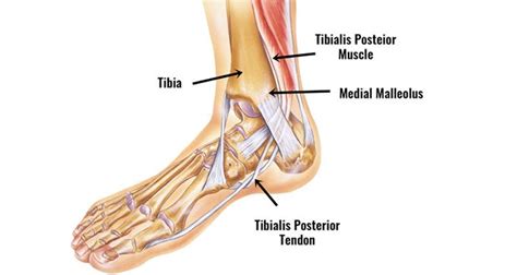 Posterior Tibial Tendon Dysfunction Pttd Symptoms Treatment