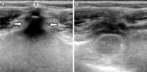 Us Guided Lumbar Puncture In A 5 Year Old 18 Kg Girl With Acute