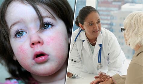 Slapped Cheek Syndrome Symptoms What Is Infection That Causes Red