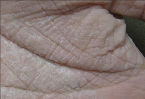 A 16 Year Old With White Plaques On The Palms—quiz Case Dermatology