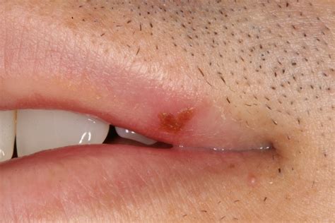 Oral herpes causes cold sores around the mouth or face. Herpes Simplex 1 Treatment - Cape Dental Care