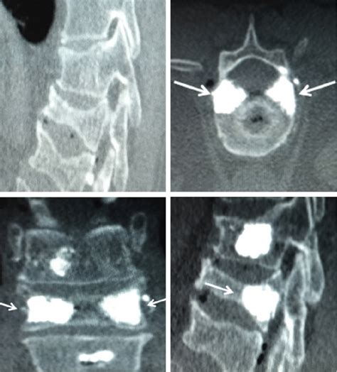 Patient With Fracture In T12 And L1 Vertebral Bodies Requiring