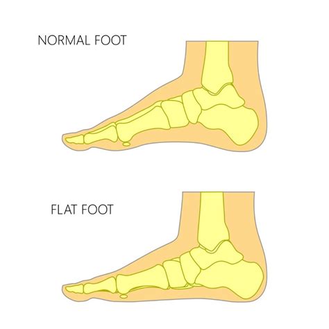 Neuro Development With Nishta Flat Feet